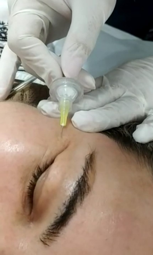 crboxiterapia facial